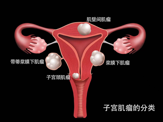 子宫肌瘤8厘米，聚焦超声消融手术需要做几次